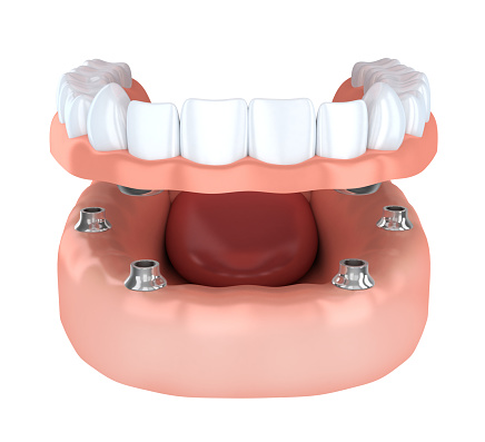 An example of denture with implants at Greashaber Dentistry in Ann Arbor, MI