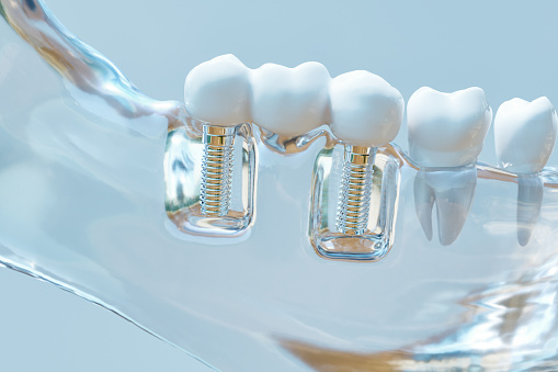 Image of dental implants at Greashaber Dentistry.