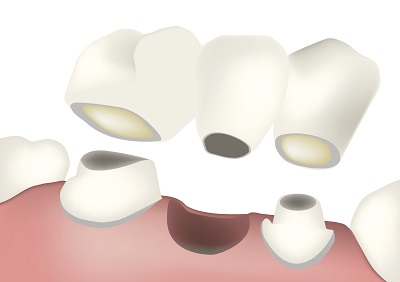 Diagram of a dental bridge from Greashaber Dentistry in Ann Arbor, MI.