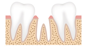 Illustration of two teeth moving closer due to a missing tooth provided by Greashaber Dentistry in Ann Arbor, MI 48104-3811