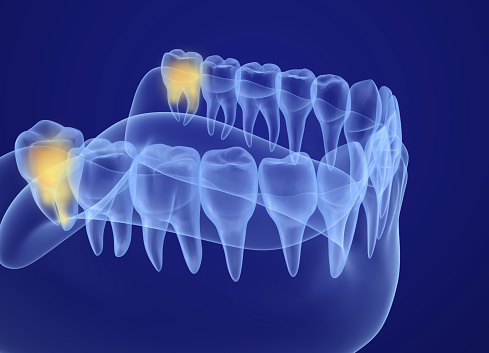 Image of impacted wisdom teeth x-ray at Greashaber Dentistry in Ann Arbor, MI.