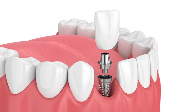 Rendering of jaw with dental implant at Greashaber Dentistry.