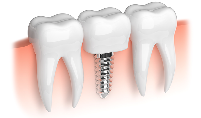 Image of a dental implant at Greashaber Dentistry in Ann Arbor, MI.