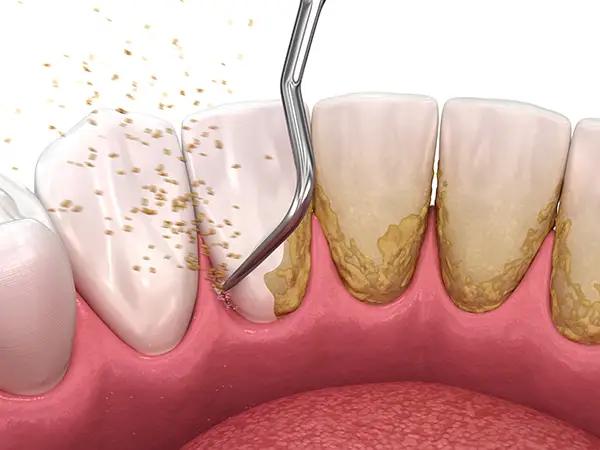 Close-up of a dental scaler removing tartar buildup from teeth during a slaling procedure.